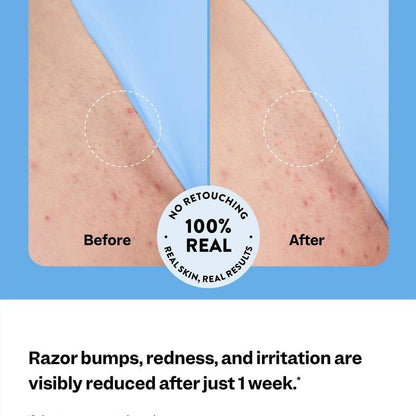 Sorrae Glow Smooth: Ingrown Hair Treatment